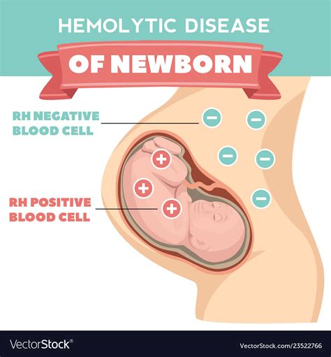 Hemolytic disease newborn infographics detailed Vector Image