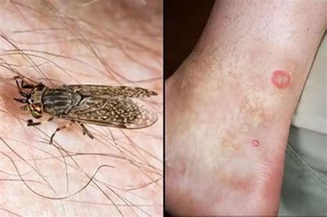 What to do if you get bitten or stung by bees, wasps, ticks, horseflies and other common insects ...