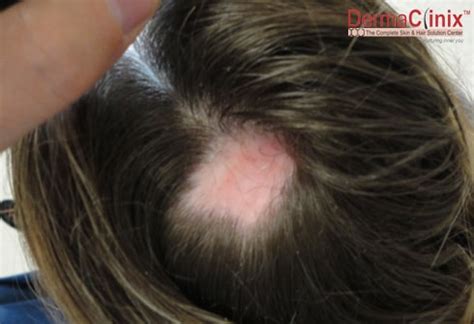 Top 67+ scarring hair loss best - vova.edu.vn