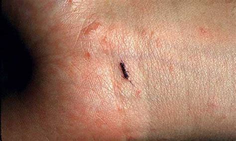 Scabies rash Look Like & Causes6