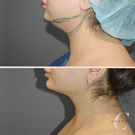 Face Liposuction Before And After