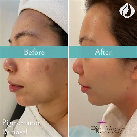 PicoWay® Laser Pigmentation Removal Toronto & North York - La Vitalité Med Spa