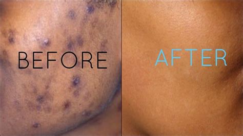 All Dark Spot Remover Creams Spf 30 1.5oz Moisturizer | Dark spot removal cream, Spots on face ...