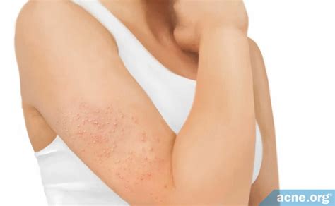 Keratosis Pilaris - Symptoms, Causes, and Treatments - Acne.org