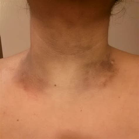 Dark Rash On Neck