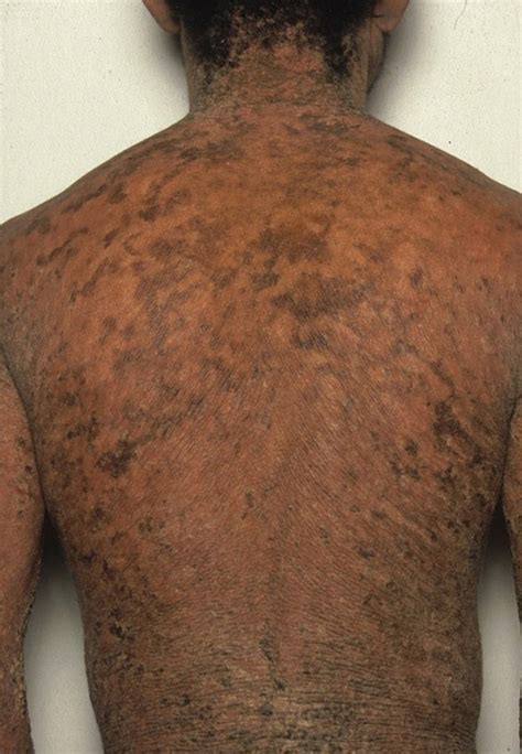 Ichthyosis vulgaris | Dermatologist