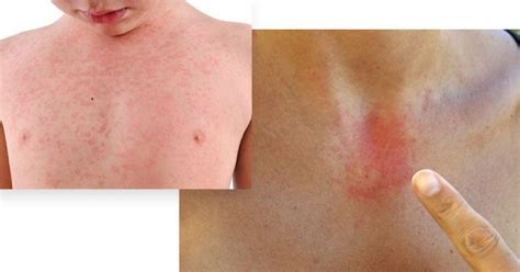 Contact Dermatitis: Causes, Symptoms, and Expert Treatment