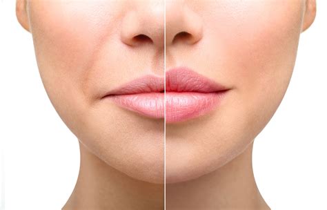 What Are The Different Types of Lip Augmentation? | South Florida Dermatology