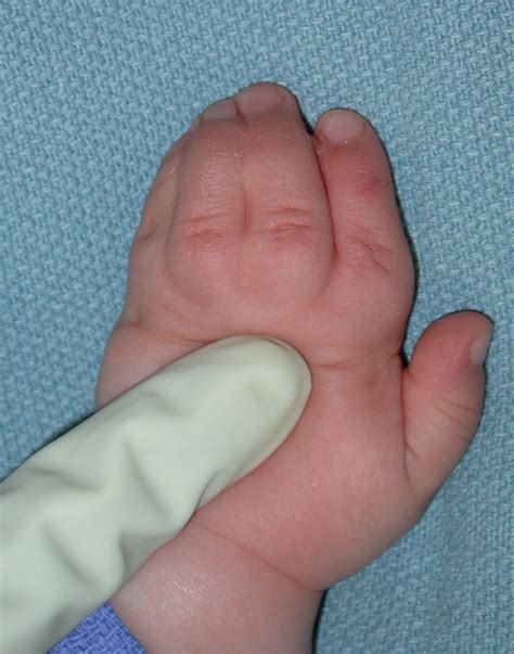 Photo of Syndactyly Involving Four Fingers | Congenital Hand and Arm Differences | Washington ...