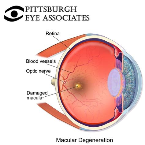 Macular Degeneration - Pittsburgh Eye Associates