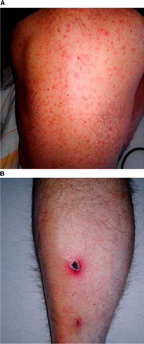 Typical exanthema and eschar in a scrub typhus patient (patient 1). (A)... | Download Scientific ...