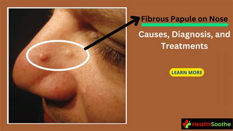 Fibrous Papule On Nose | Causes, Diagnosis, And Treatments