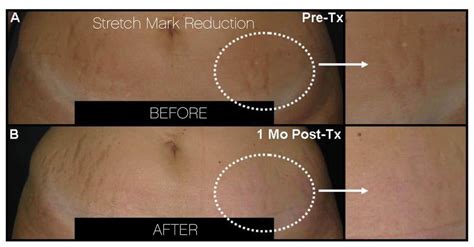 How To Get Rid Of Stretch Marks | Toronto | SpaMedica