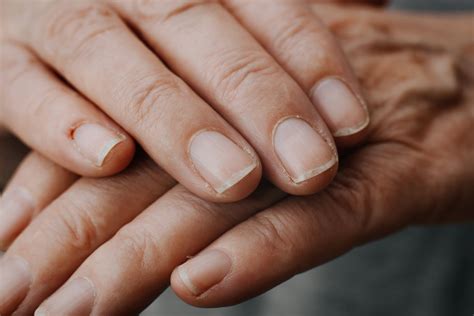 Nails With Toenail Fungus: The Wonders of Baking Soda For Nail Fungus Treatment