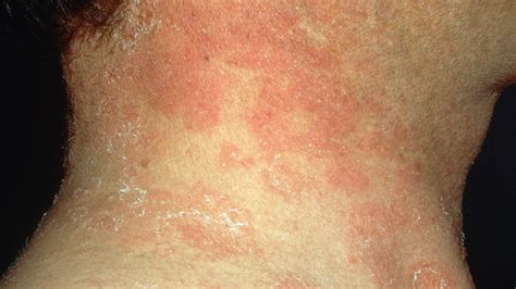 Skin Cancer Rash On Back