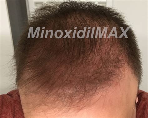 Minoxidil With Finasteride Topical Solution Dualgen-15 With