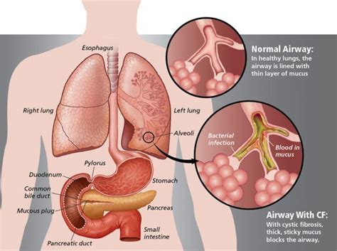 3-Ingredient Remedy That Clears Lung Mucus Immediately | Clear lungs ...