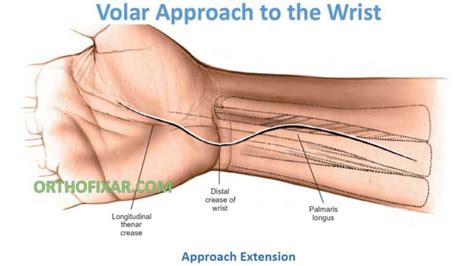 Volar Approach To The Wrist | OrthoFixar 2024