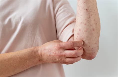 Urticaria: Symptoms, Causes, and Treatment