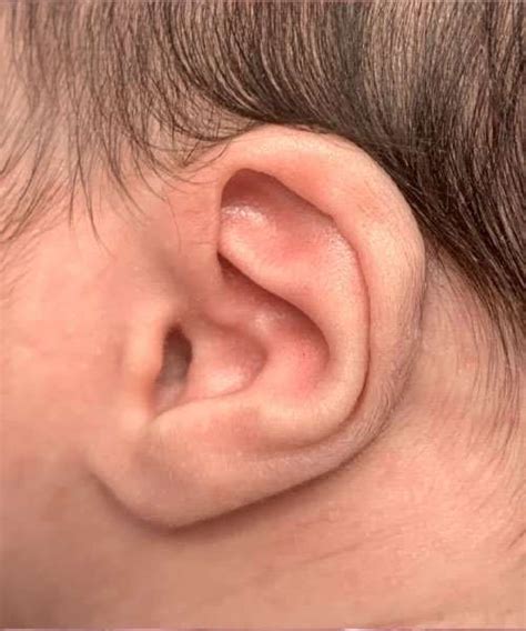 Newborn Ear Correction Case 1162 - Aviva Plastic Surgery