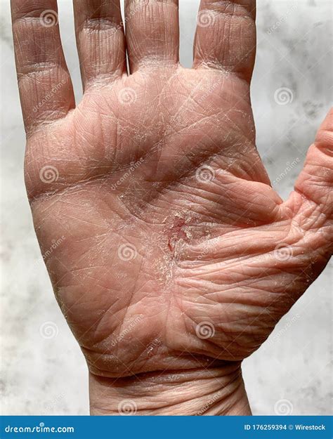 Vertical Shot of a Hand with a Dry Cracked Skin Stock Photo - Image of ...