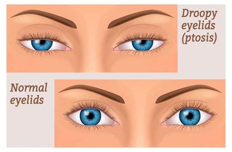 Tackling Heavy Eyelids: Causes, Non-Surgical & Surgical Treatments - Vegas Liposuction