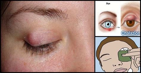Home Remedies And Effective Treatments For Chalazion | Dr Farrah MD