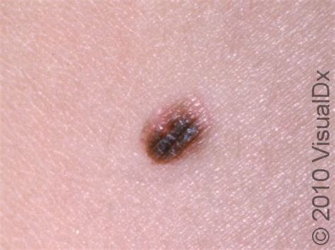 Mole (Nevus) Condition, Treatments and Pictures for Children - Skinsight