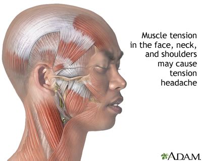 HIE Multimedia - Tension headache