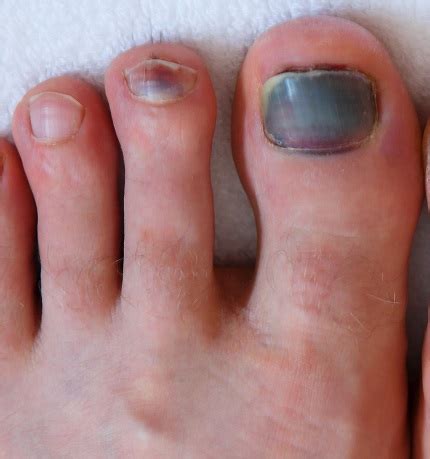 Black Spot On Toenail Near Cuticle - Nail Ftempo