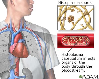 Histoplasmosis Information | Mount Sinai - New York