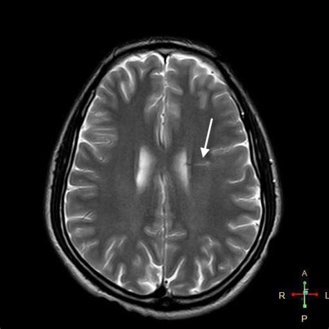 Developmental venous anomaly | Eurorad