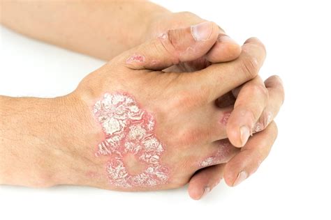 Eczema vs. Psoriasis: How to tell which one it is?