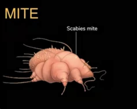 SCABIES: Types, Causes, Symptoms, Diagnosis and Treatment