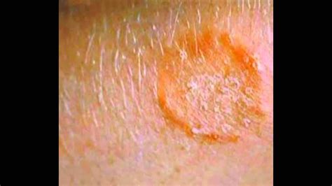 Skin Fungus Signs Symptoms Treatment HD - YouTube