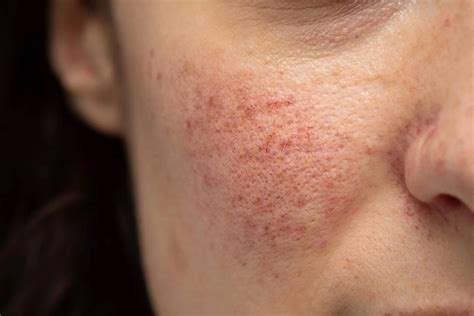 Oxymetazoline Cream for Rosacea Treatment - Strut Blog