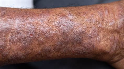 How Does Atopic Dermatitis Present in Skin of Color?