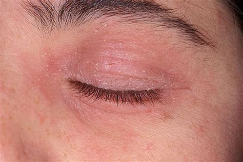 What Causes Itching Eyelids and How to Help? (2024)