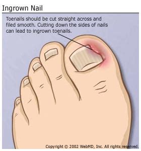 Really Bad Ingrown Toenail ~ Ingrown Toenail