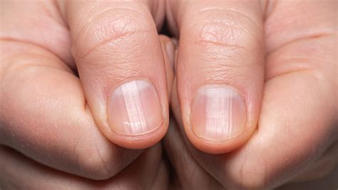 Why Do My Fingernails Have Vertical Ridges - Design Talk