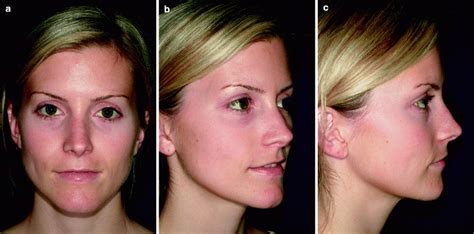 of Dermatological Laser Treatment | Plastic Surgery Key