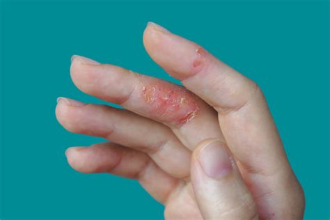 Understanding Eczema on Hands: Causes, Treatments and Prevention - hub.health