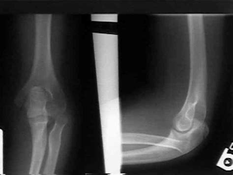 Congenital Dislocation of Radial Head : Wheeless' Textbook of Orthopaedics