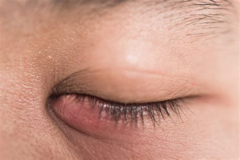 Blocked Tear Duct – Symptoms, Causes, and Treatment | Diamond Vision