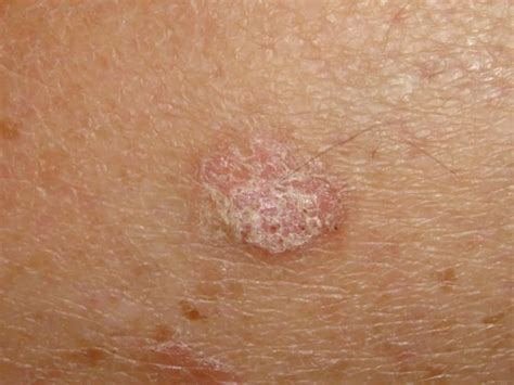 Solar Keratosis: Symptoms, Causes And Complications