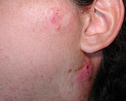 Postauricular Lymphadenopathy