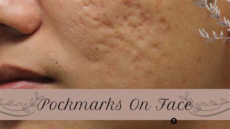 Pockmarks On Face - Meaning, Causes, & Best Treatments