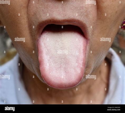 Coated tongue or white tongue of Asian, Chinese woman. It appears with white layer when debris ...