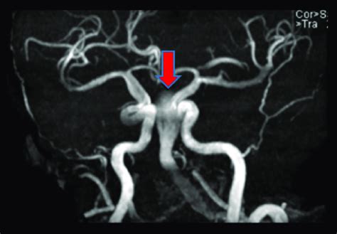 Case 1. Head and neck magnetic resonance angiography (MRA). Head and ...