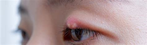 What is a Stye? (aka Hordeolum) Stye Symptoms and Treatments